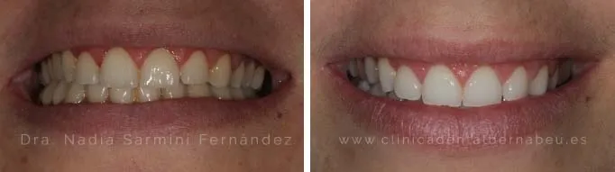 Antes y después | Blanqueamiento con férulas o cubetas.