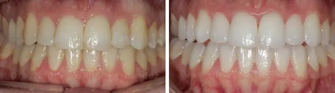 Antes y después | Blanqueamiento con férula o cubeta.