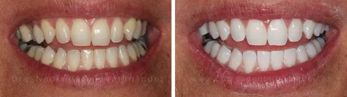Antes y después | Blanqueamiento