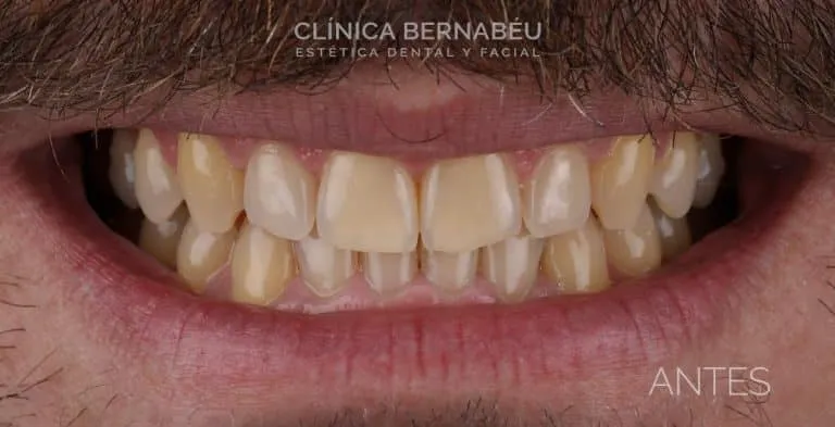 un tipo de carilla de porcelana antes del tratamiento