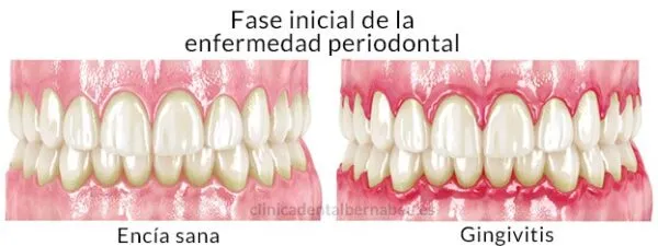 Gingivitis, diferencia con la periodontitis