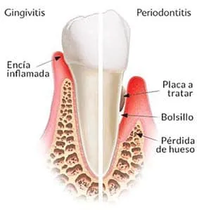 gingivitis sintomas