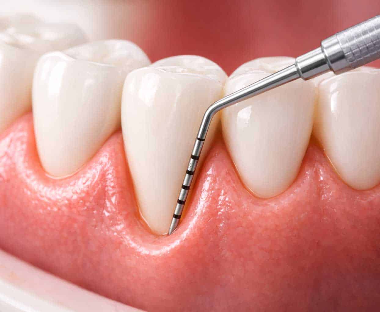 Periodoncia y encías