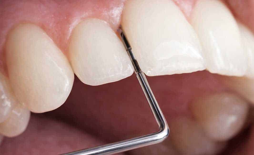 Diagnóstico de periodontitis