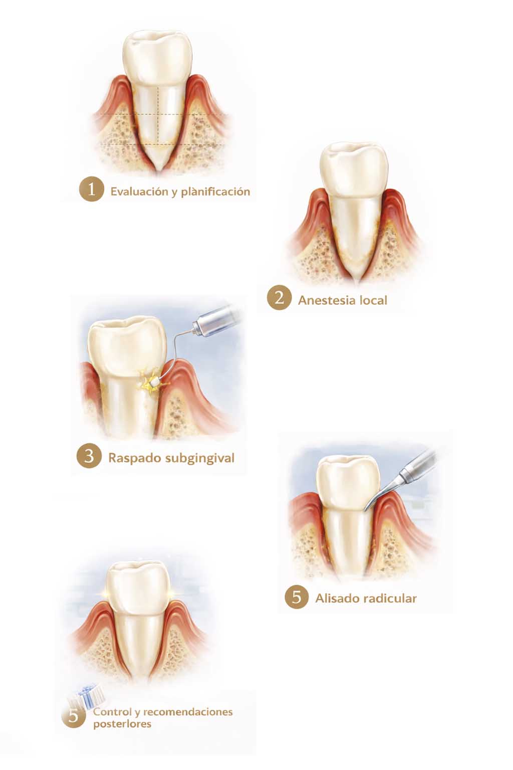 Procedimiento de curetaje dental