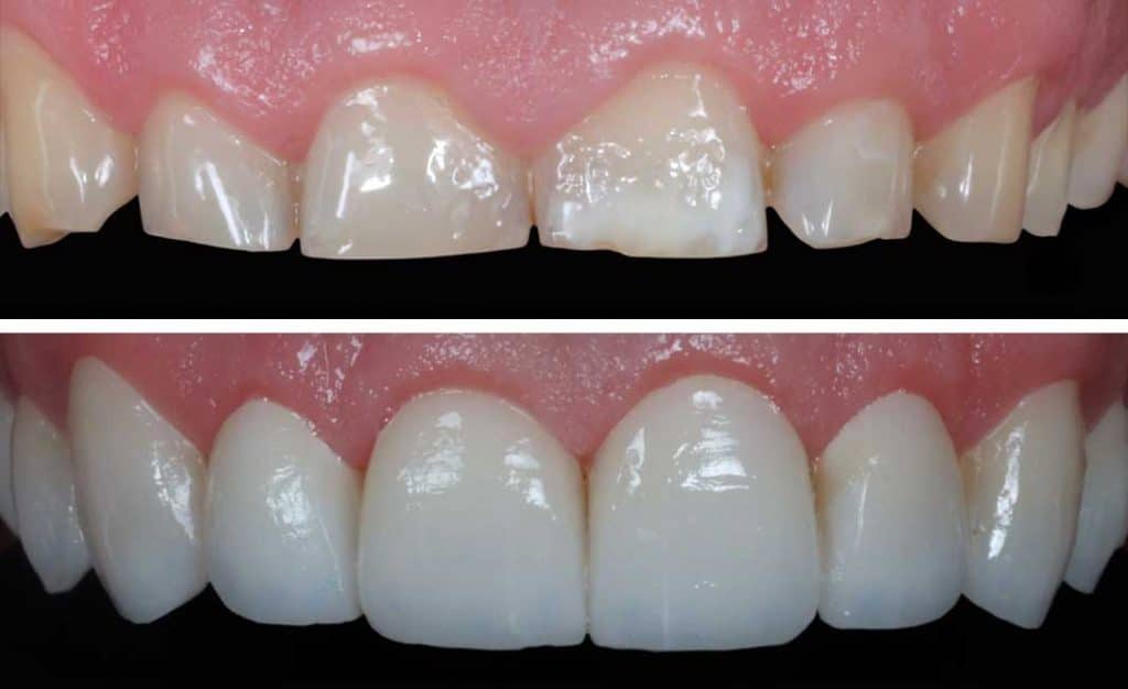 Desgaste dental por bruxismo