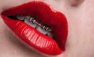 ¿Qué brackets son los adecuados para mi caso?