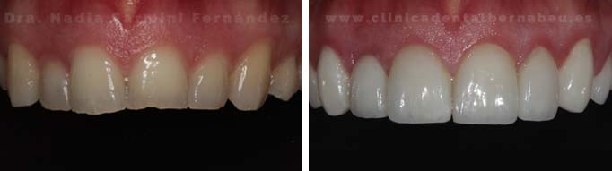 y después de carillas E-max tras Diseño Digital de Sonrisa