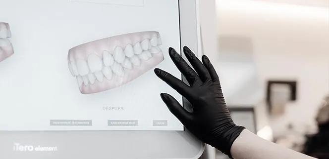 Simulación digital 3D de la sonrisa en clínica dental Madrid