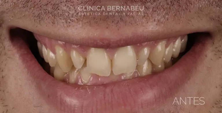 Antes del tratamiento de estética dental en Clínica Dental Bernabéu Madrid