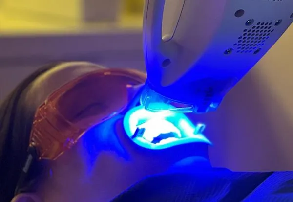 Luz azul de la lámpara concentrada en la boca abierta, con gafas naranjas de protección