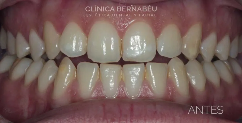 Caso real después de estética dental