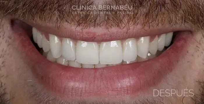 Sonrisa masculina después del tratamiento de estética dental, con los bordes incisales a la misma altura