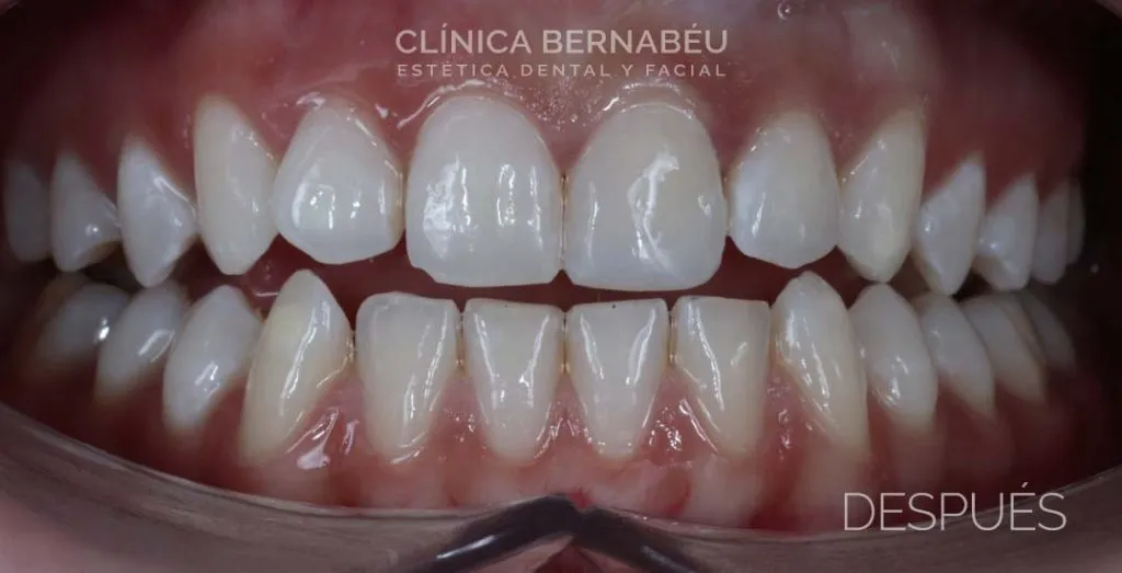 Caso real después de estética dental