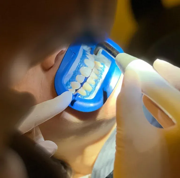 Protección de encías antes del blanqueamiento dental en clínica