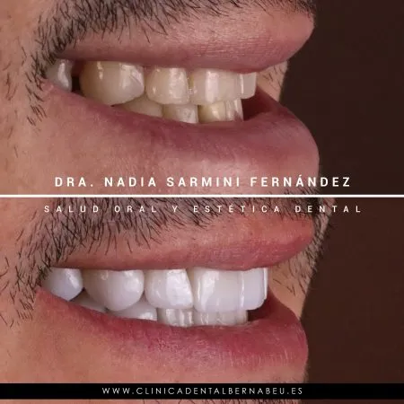 Antes y después de un caso de estética dental en vista lateral, firmado por la Dra. Nadia Sarmini Fernández