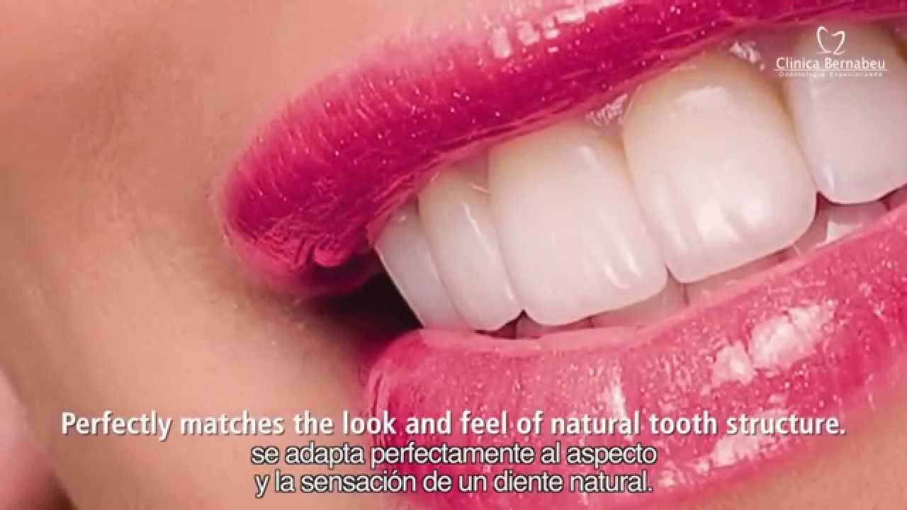 Fotograma del v&iacute;deo de Cl&iacute;nica Dental Bernab&eacute;u sobre el tratamiento con carillas de porcelana E-max