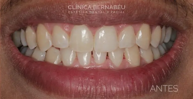 Sonrisa con los dientes amarillentos, rotulada como ANTES en la comparativa de blanqueamiento