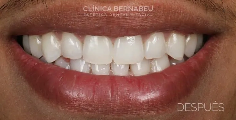 Sonrisa con el tono ya aclarado, rotulada como DESPUÉS en la comparativa de blanqueamiento